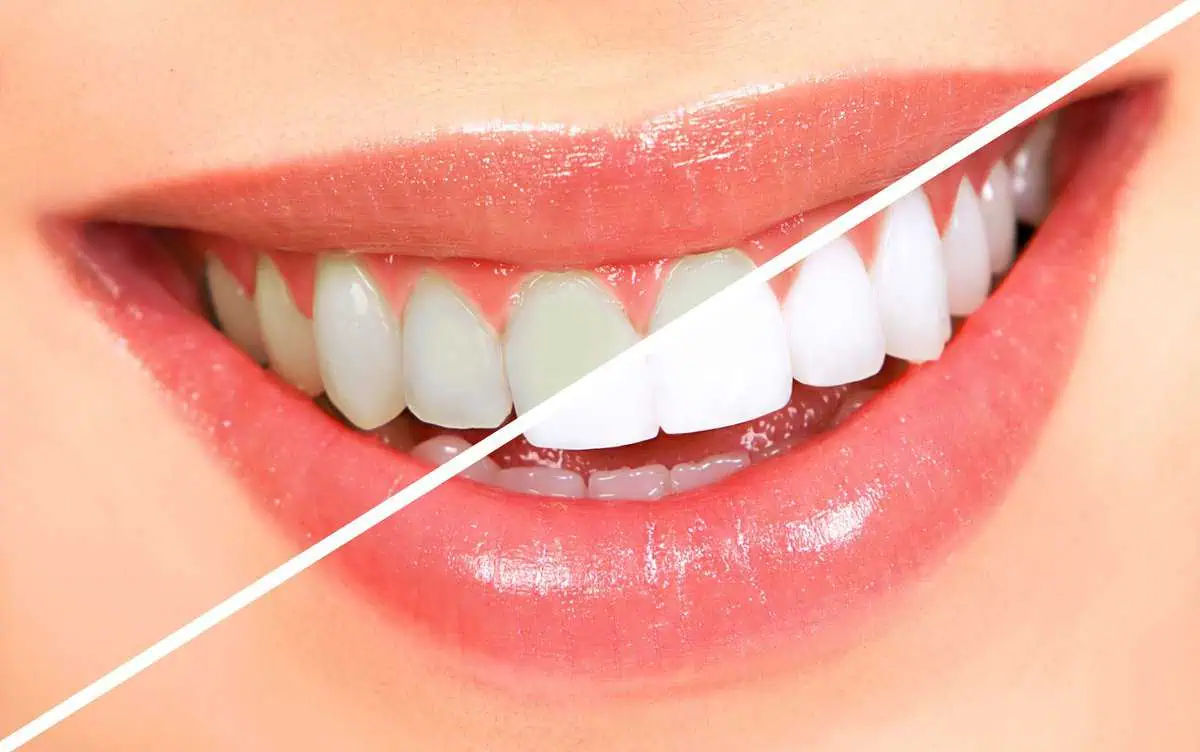 The-Top-Benefits-of-Whitening-Your-Teeth-A-Brighter-Smile-Awaits